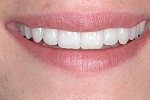 teeth after procedures: correct headaches, migranes, sleep apnea, bruxing and tmj problems teeth after procedures: correct headaches, migranes, sleep apnea, bruxing and tmj problems